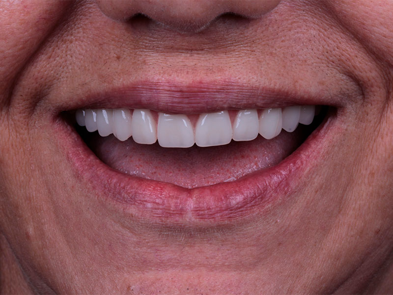 Implantes dentários Oral Person Campo Grande